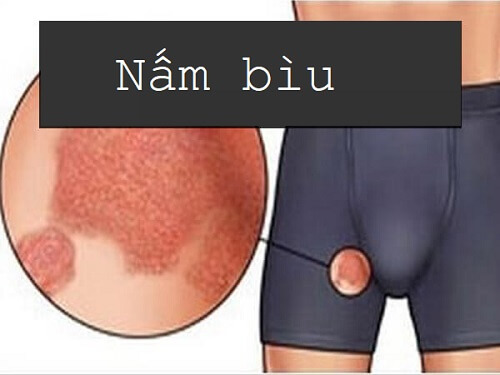Nổi mẩn đỏ ở bìu do nấm